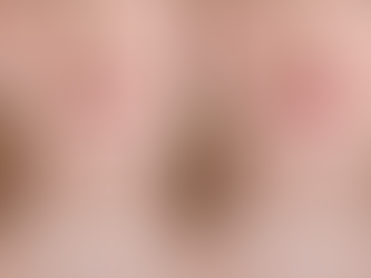 Natural vs volume lip filler comparison showing subtle vs fuller results