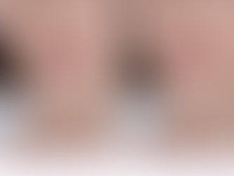 lip flip vs lip filler comparison natural results