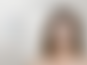 A diagram of Dermal Filler Treatment areas on a woman's face