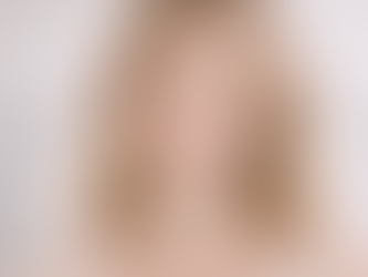 Facial balancing dermal filler areas including cheeks chin jawline and lips