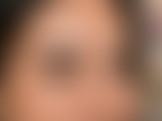 botox crow's feet natural eye area results