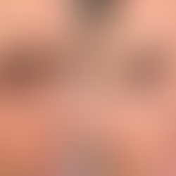 tear trough vs under eye filler results