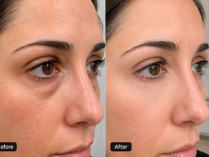 tear trough vs under eye filler results
