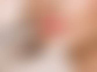 Lip Filler Injection