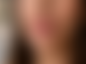 lip fillers santa monica natural results