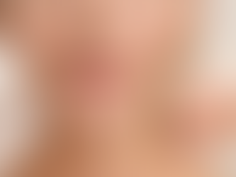 smile lines treatment before after natural results