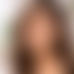 non surgical facial rejuvenation santa monica