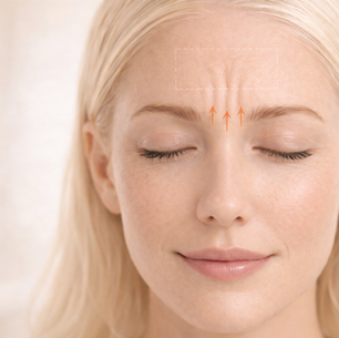 Botox for frown lines between eyebrows