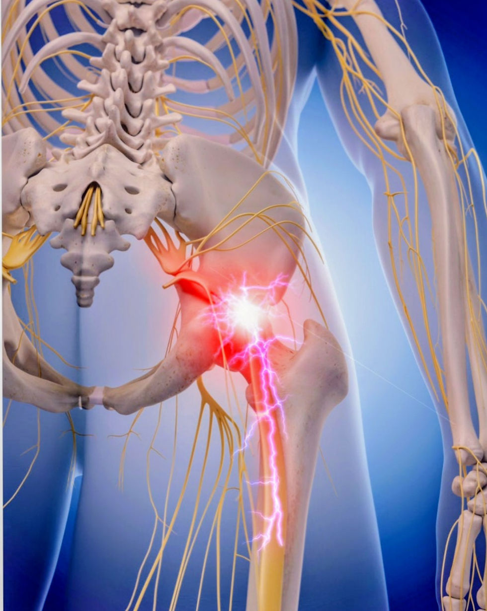 6 STEP SCIATICA ELIMINATOR