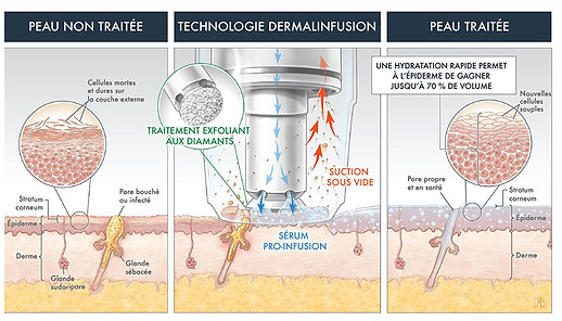 Dermalinfusion-Technology-FRV2.jpg