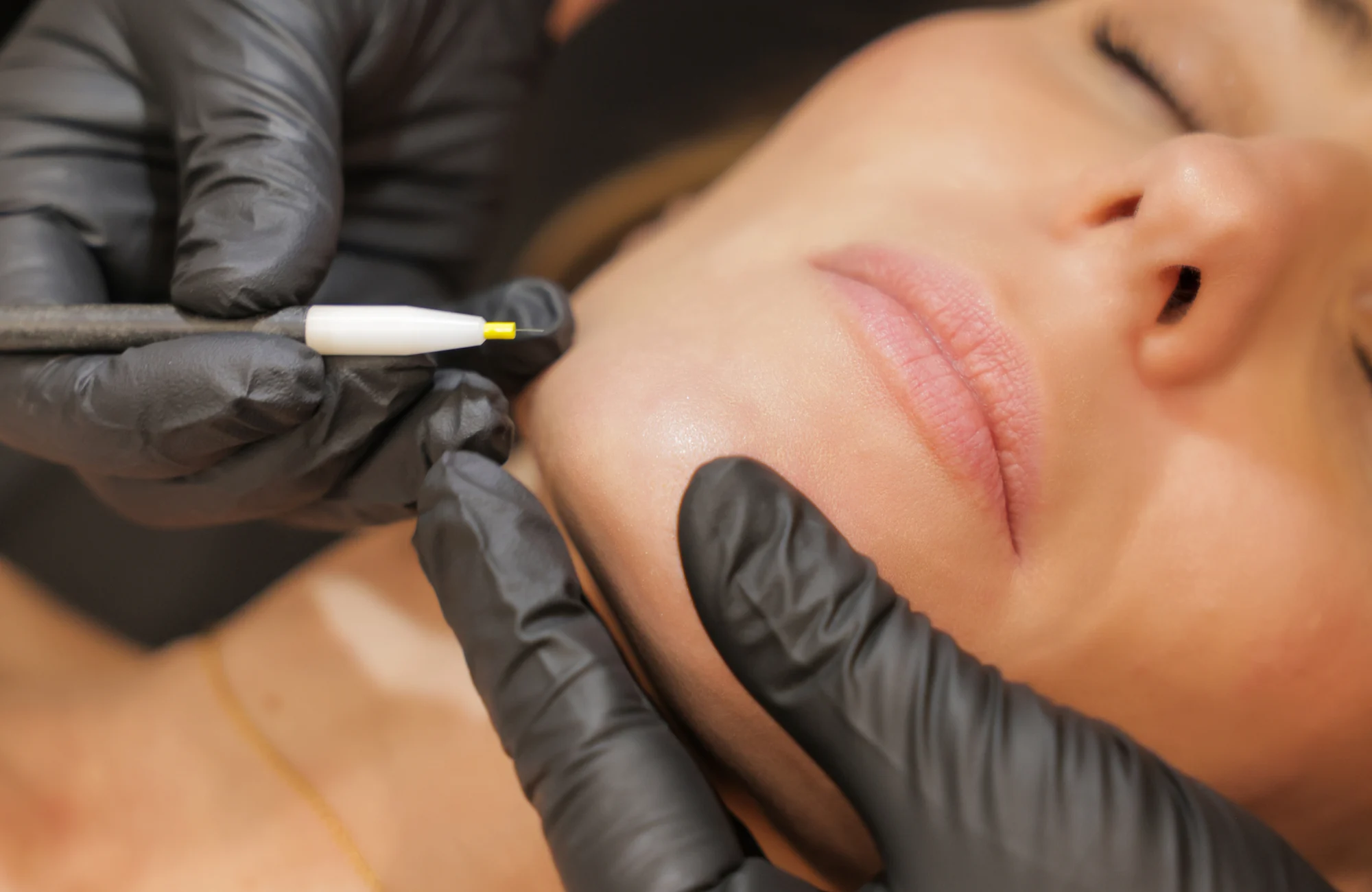 Client receiving electrolysis treatment