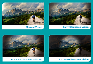 understanding_what_is_glaucoma.png