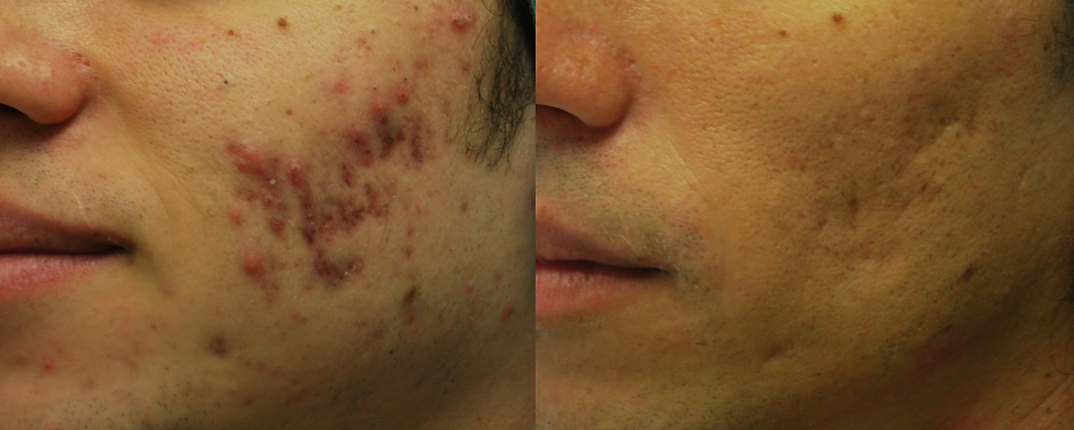 Morpheus8 Before & After (2).png