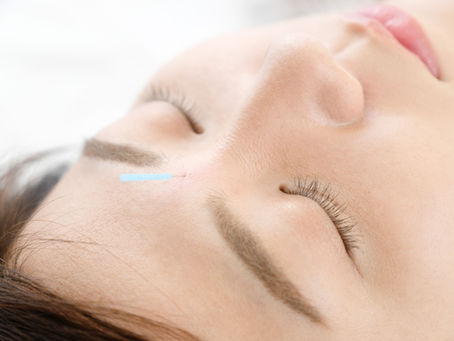 Acupuncturist treating a patient for stress and anxiety at Union Yoga & Physical Therapy in Annandale, VA.