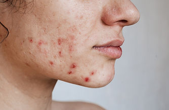 Micro Needling in Annandale, VA