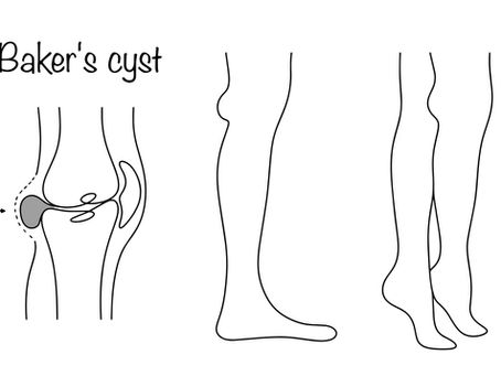 Woman performing glute bridge exercise for Baker’s cyst and knee pain relief during physical therapy.