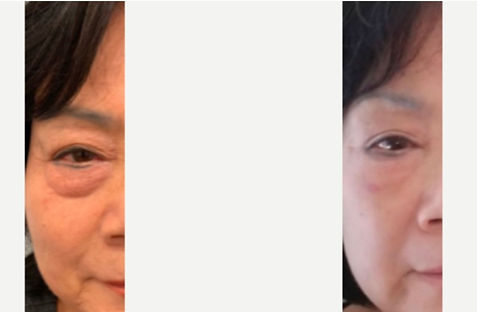 Nano Needling for under eye lift in Annandale, VA