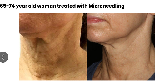 Microneedling in Annandale, VA