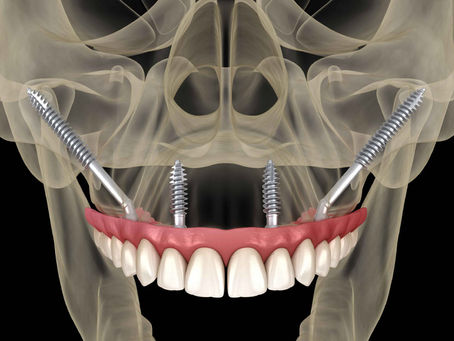 O que precisa de saber sobre a técnica dos implantes zigomáticos