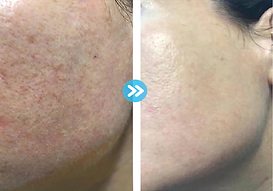 post facial for acne treatment