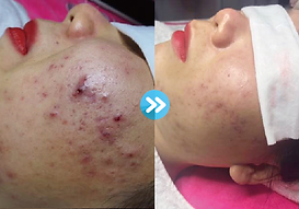 acne facial treatment