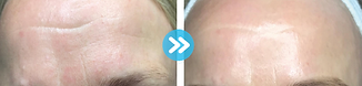 before and after microneedling