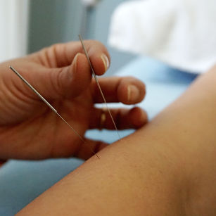 Acupuncture