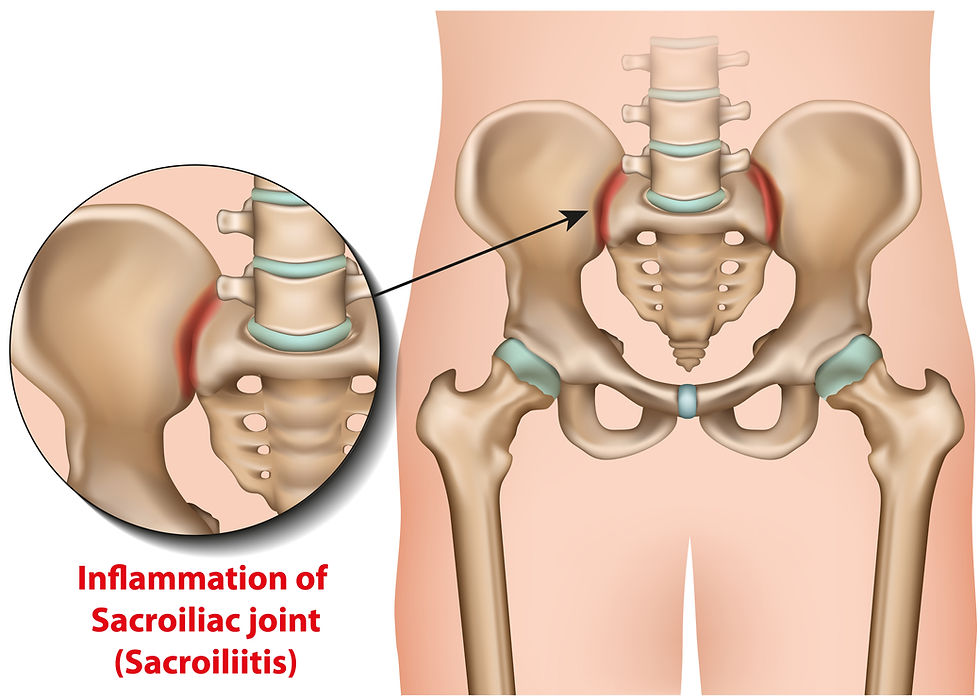 Sacroiliac Joint Dysfunction