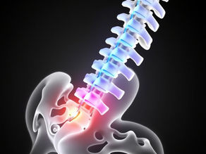 Can You Train With a Lumbar Stress Fracture?