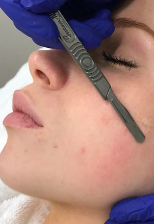 Dermaplaning