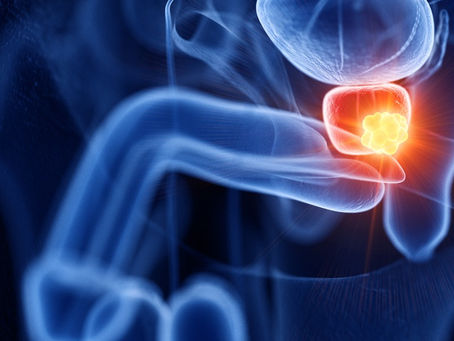 What Causes Prostate Cancer?