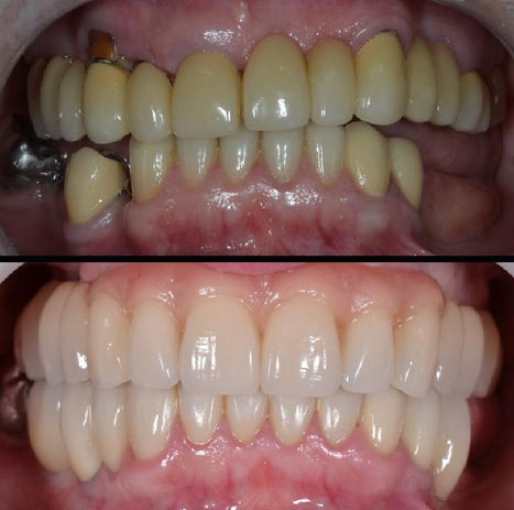 IMPLANTES DENTÁRIOS