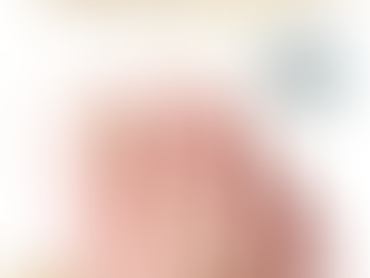 Tratando onicomicose com Laser ND YAG