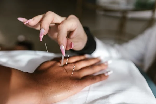 A woman receiving acupuncture