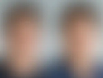 Exemplo de reconstrução após trauma facial