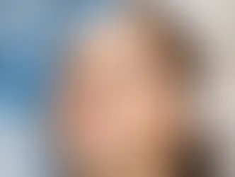Rinoplastia ou preenchimento nasal?