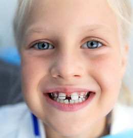 Glückliches Kind zeigt mit offenem Mund seine lose Zahnspange