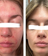 1:1 client acne transformation