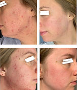 1:1 client acne transformation