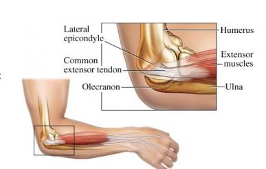 Lateral Epicondylalgia (Tennis Elbow)