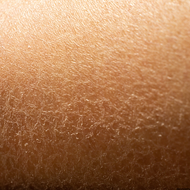 Dry Skin