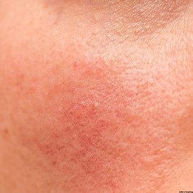 Sensitive Skin