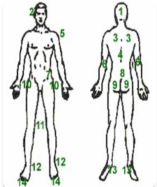 Common sites of the pressure ulcers