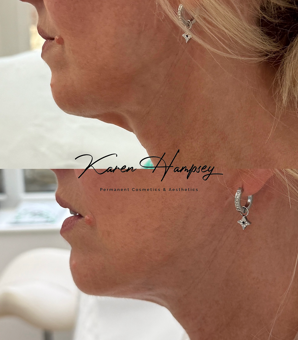 Endolift Chesterfield