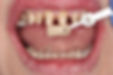 Stump Shade on Prepped Teeth