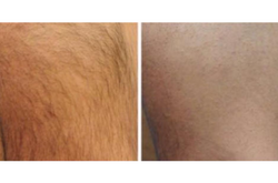 Laser Hair Removal