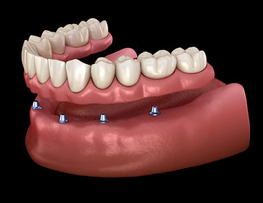 all on X, all on 4, all on 6, denture over implants