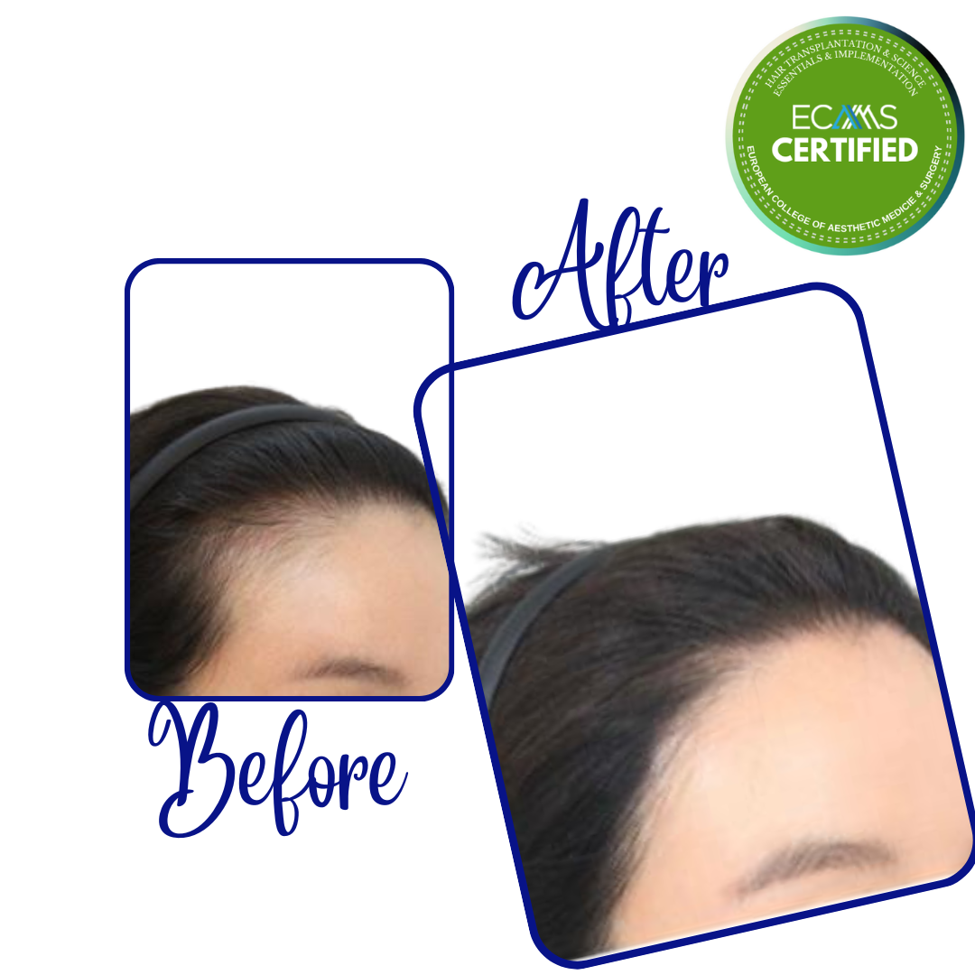 Case 22 before-and-after composite showing female temporal hairline restoration at FUEHUB Cyprus.