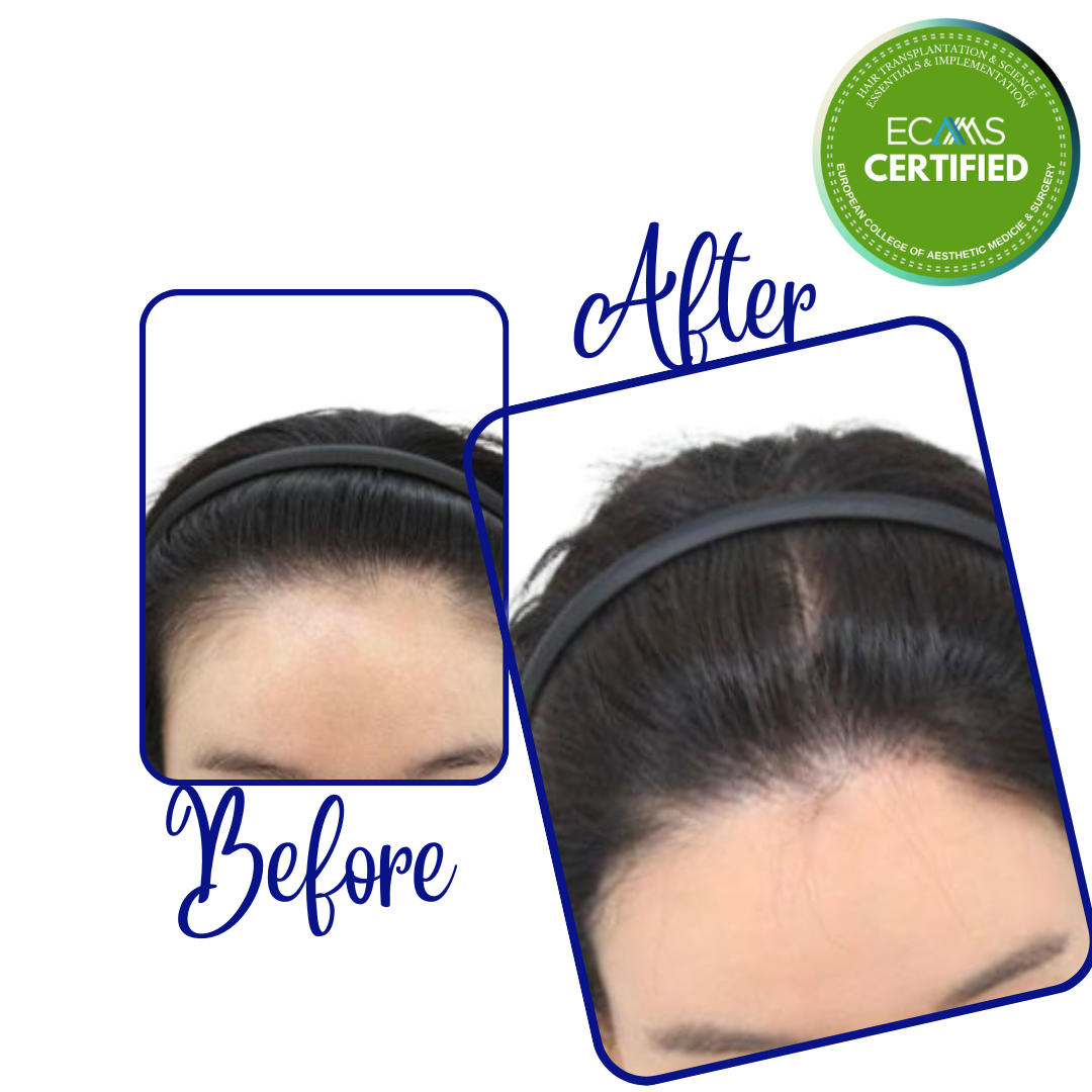 Case 23 before-and-after composite showing female frontal hairline restoration at FUEHUB Cyprus.
