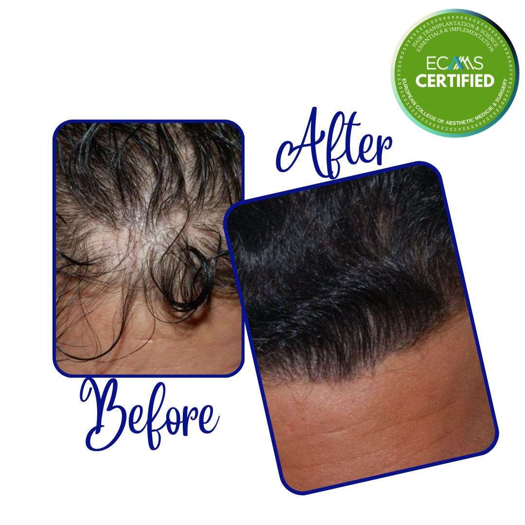 Case 11 before-and-after composite showing frontal hairline density restoration at FUEHUB Cyprus.